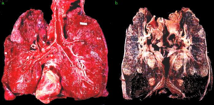 before and after smoking lungs. this efore and after of